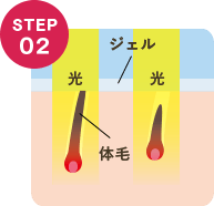 脱毛の手順：２